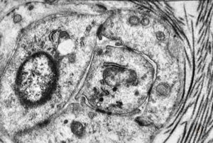 F,42y. | pseudoangiomatous hyperplasia